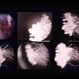 Eales Disease Eales Disease